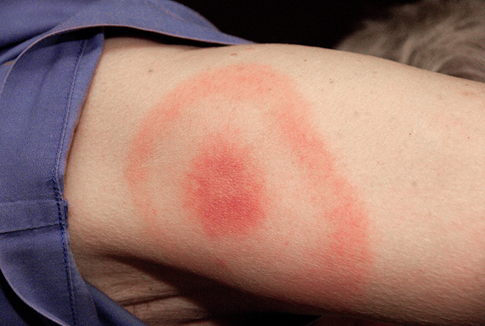 lyme disease rash bulls eye spot tick bite